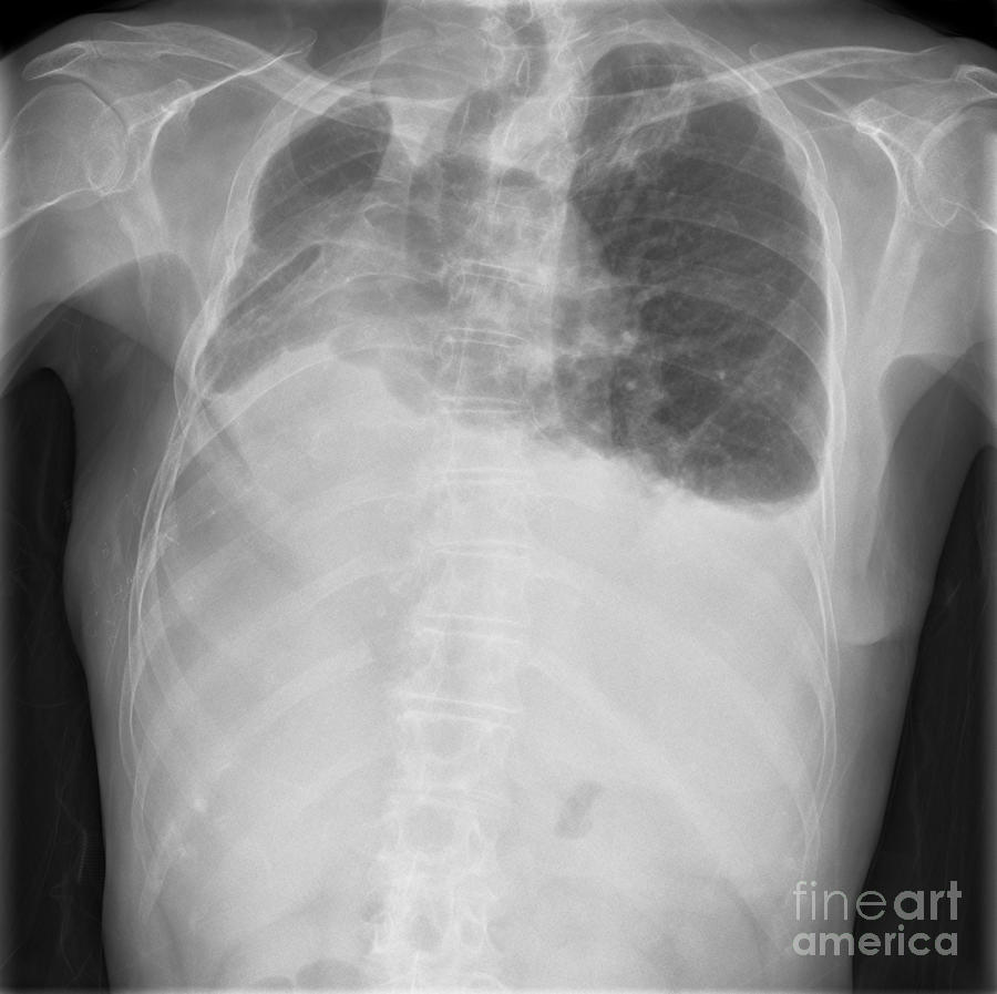 Lung Disease, X-ray Photograph by Science Photo Library - Fine Art America