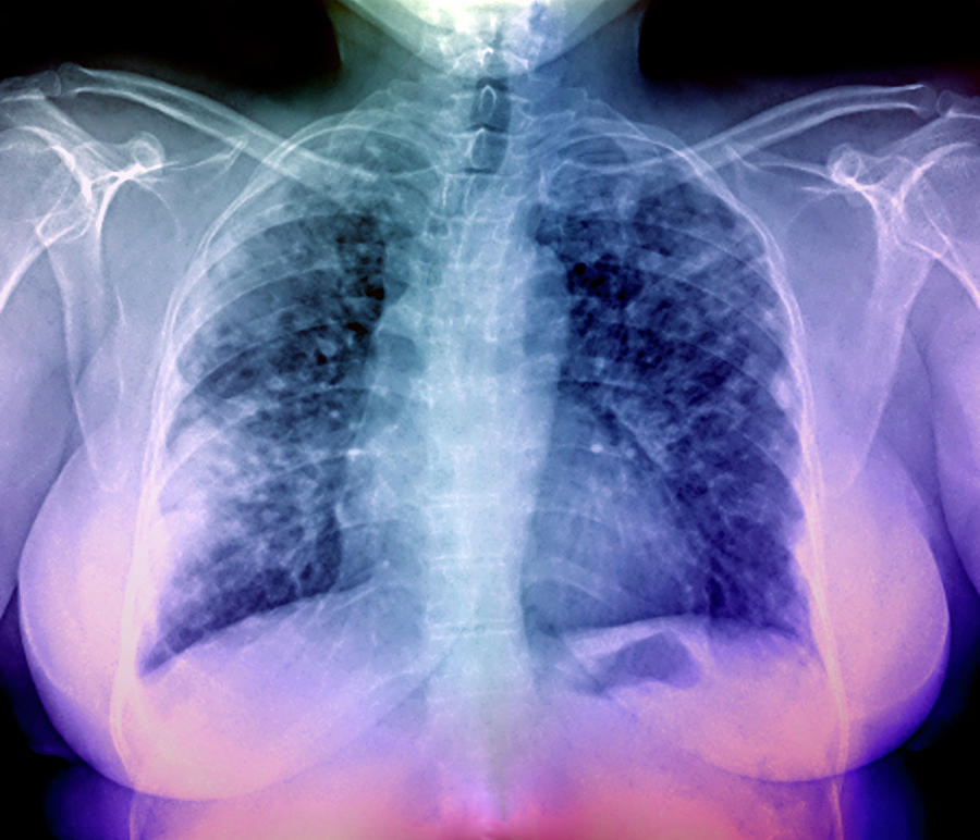 Lung Disease Photograph by Zephyr/science Photo Library