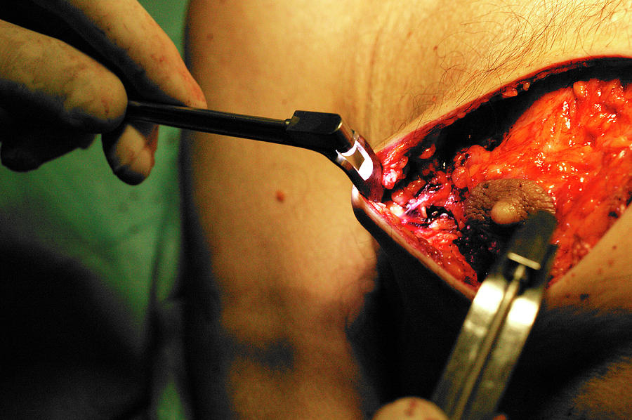Male Breast Reduction Surgery #2 Photograph by Mauro Fermariello/science Photo Library