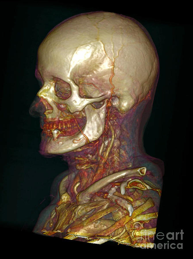 Male Skull & Arterial System #2 Photograph by Scott Camazine