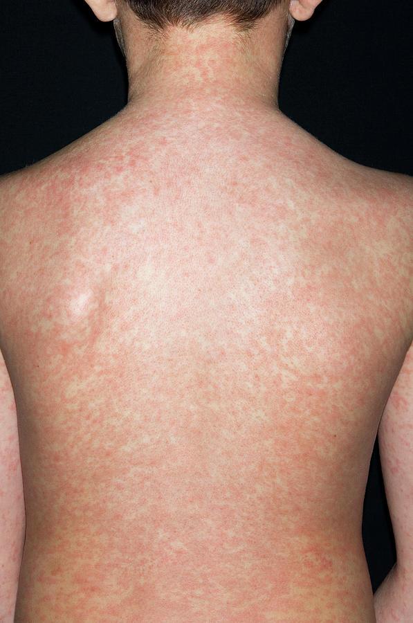 Measles Rash Photograph by Dr P. Marazzi/science Photo Library