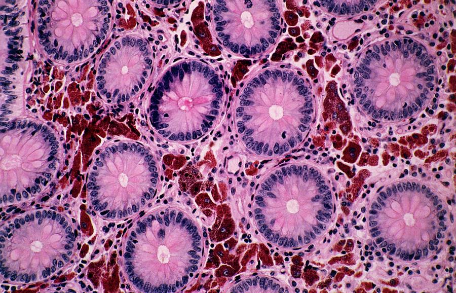 Melanosis Coli #2 Photograph by Cnri