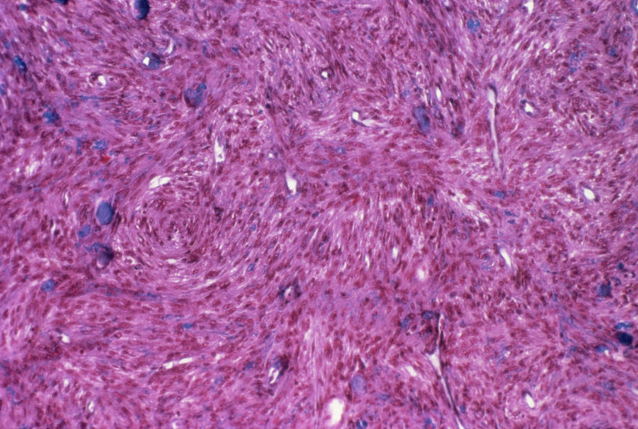 Meningioma Brain Tumour #2 Photograph by Cnri/science Photo Library