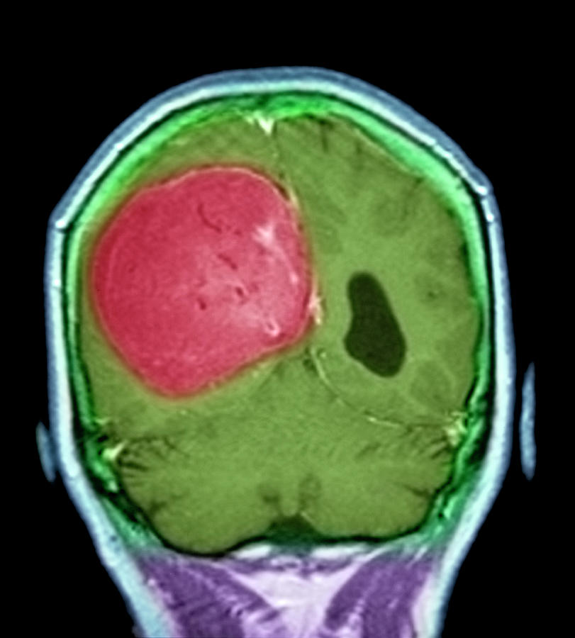 Meningioma Brain Tumour Photograph By Dr P Marazzi Science Photo ...