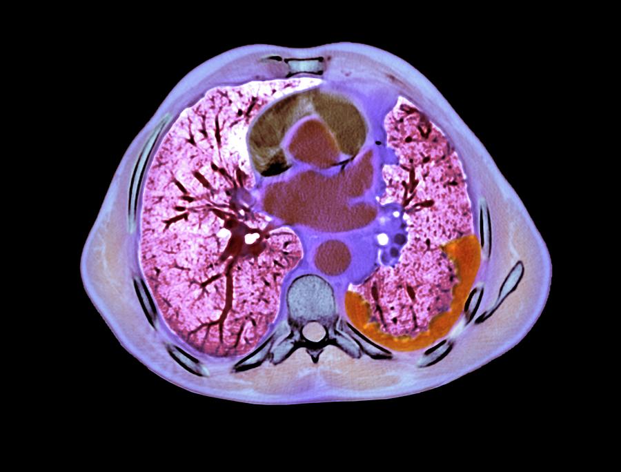 Mesothelioma Lung Tumour #2 Photograph by Du Cane Medical Imaging Ltd