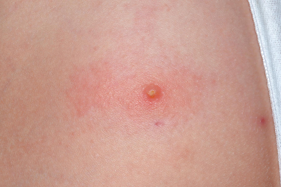 Mollusken Contagiosa