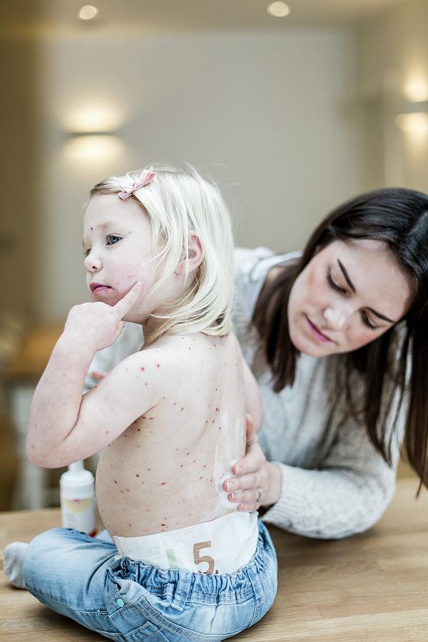 Mother Treating Daughter With Chickenpox #2 Photograph by Samuel Ashfield/science Photo Library
