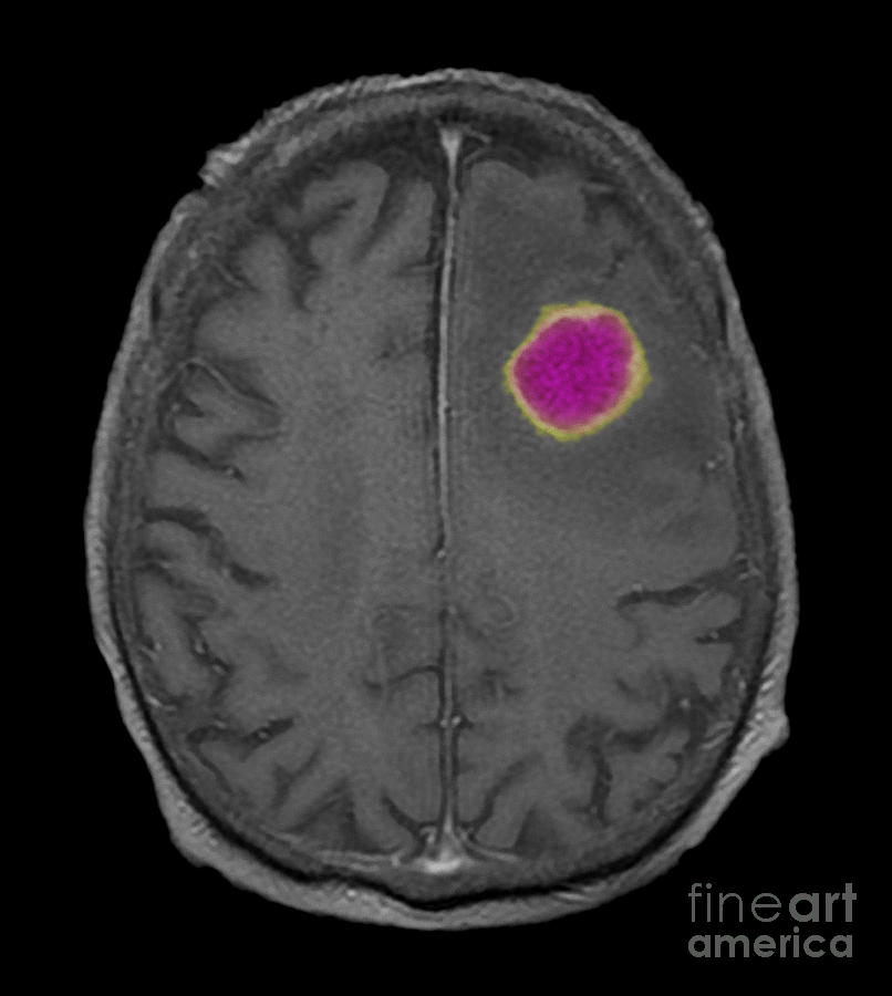 Mri Of Encapsulated Abscess In Frontal #2 Photograph by Scott Camazine