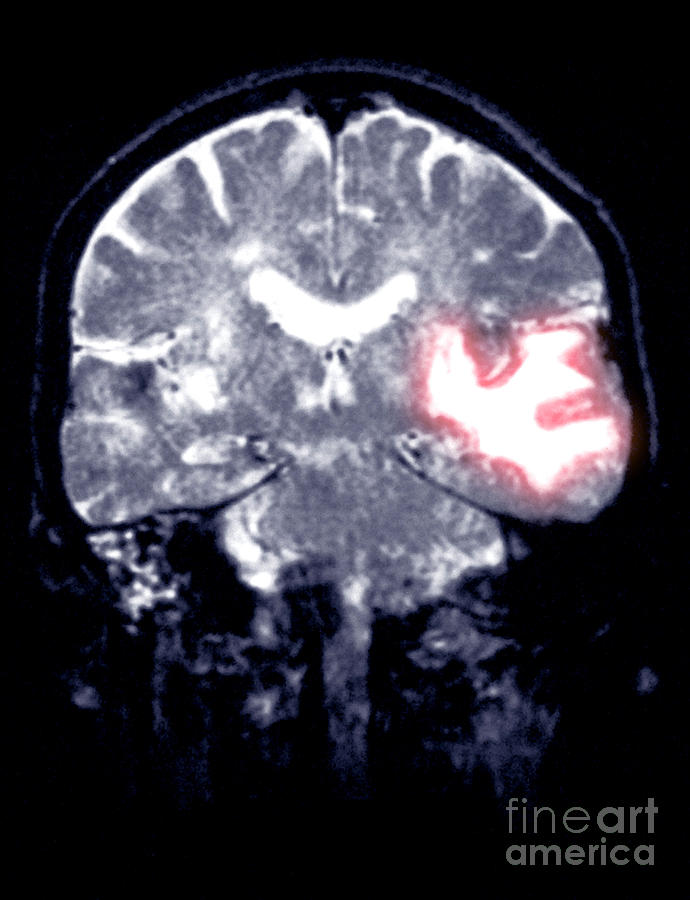 Mri Scan Of A Brain Hemorrhage #2 Photograph by Scott Camazine