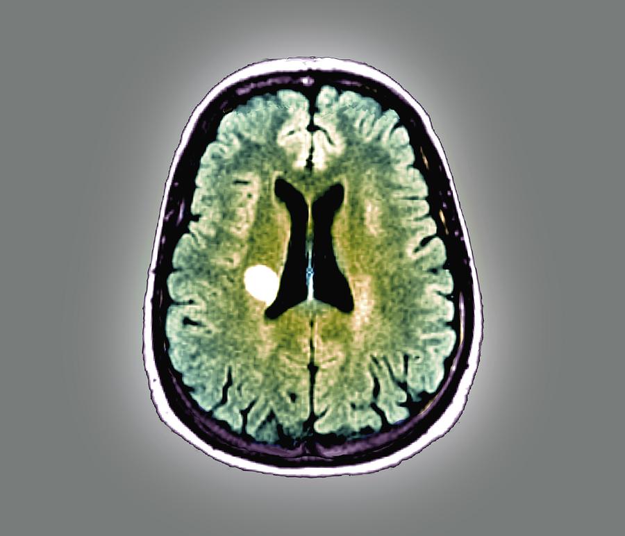 Multiple Sclerosis #2 Photograph by Zephyr/science Photo Library