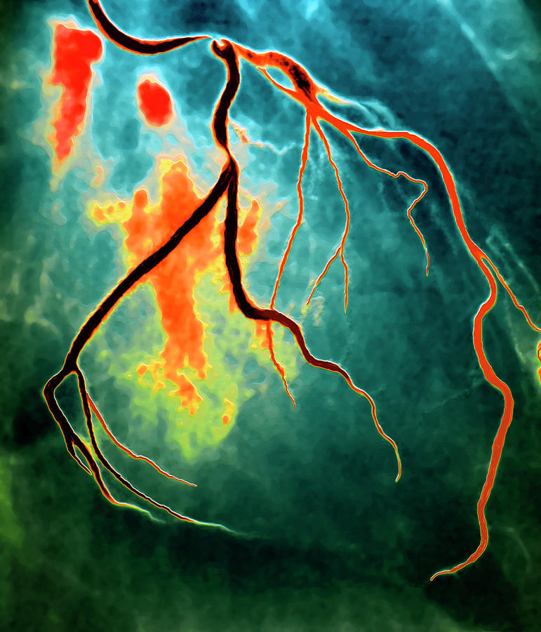 Blood Vessel Photograph - Narrowed Coronary Artery #2 by Zephyr/science Photo Library