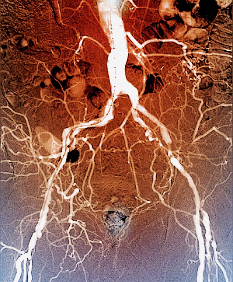 Atherosclerosis Photograph - Narrowed Iliac Artery #2 by Zephyr/science Photo Library
