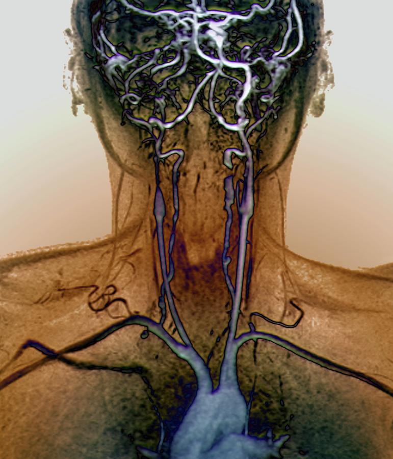 Neck And Brain Aneurysms #2 Photograph by Zephyr/science Photo Library