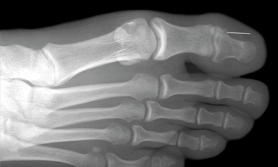 Needle Stuck In Toe #2 Photograph by Du Cane Medical Imaging Ltd