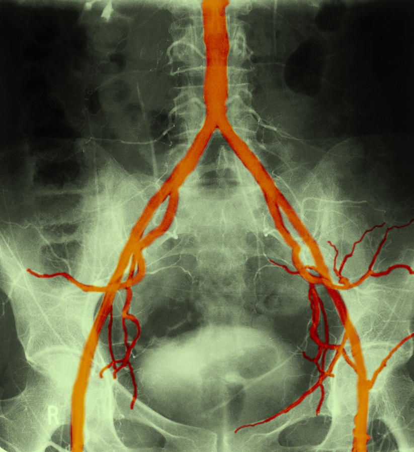 Normal Arteriogram #2 Photograph by John Watney