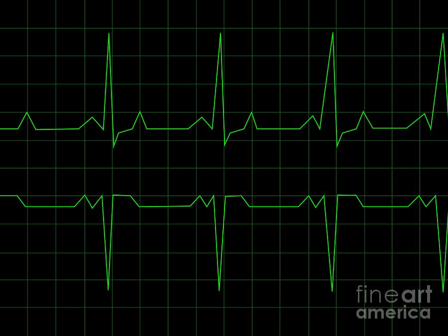 normal heartbeat