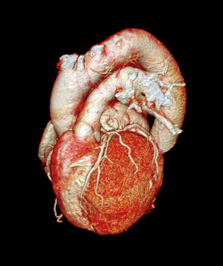 Normal Heart #2 Photograph by Zephyr/science Photo Library