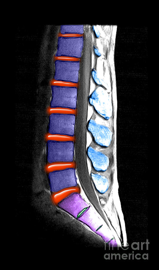 Normal Lumbar Spine, Mri #3 Photograph by Living Art Enterprises