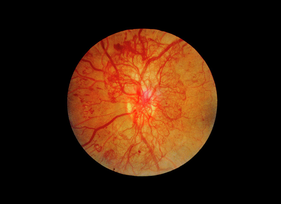 Ophthalmoscopy Of Eye With Diabetic Retinopathy Photograph By Paul My