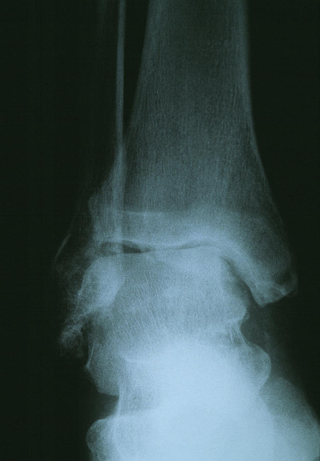 Osteoarthritis Of The Ankle Photograph By Dr P Marazzi Science Photo Library