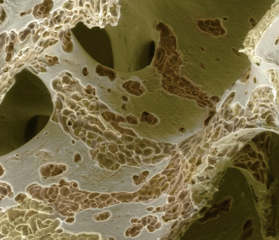 Osteoporosis Photograph - Osteoporosis #2 by Dr Tony Brain/science Photo Library