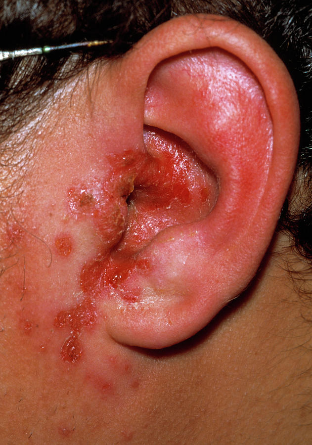 Outer Ear Infection Photograph By Dr P Marazziscience Photo Library 