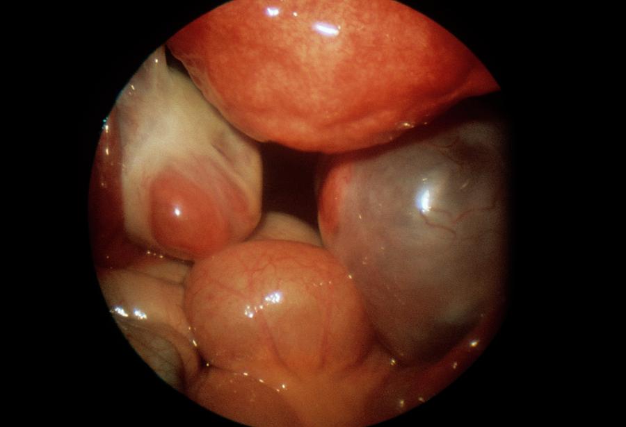 Ovarian Cyst Photograph by Dr J. P. Abeille/science Photo Library