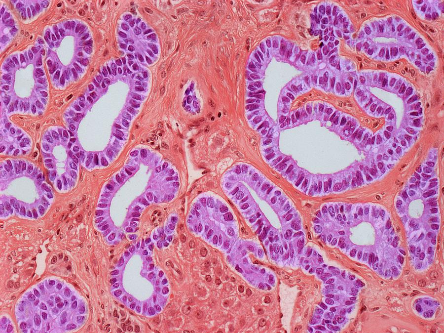 Ovarian Sertoli-leydig Tumour #2 Photograph by Steve Gschmeissner