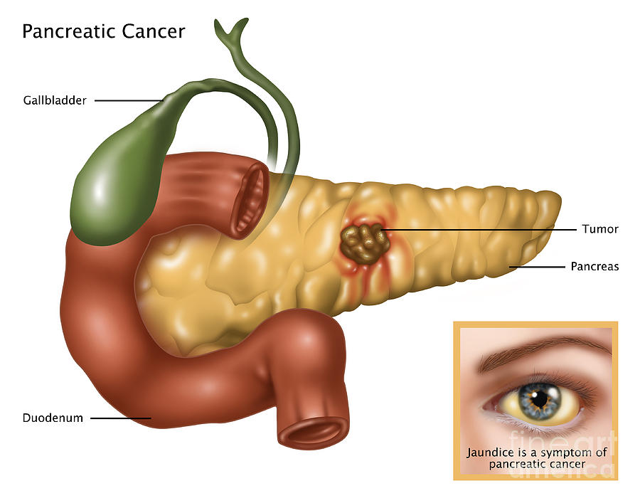 Pancreatic Cancer, Illustration #2 Photograph by Gwen Shockey