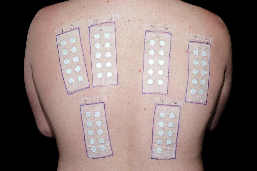 Patch Testing For Allergies Photograph by Dr P. Marazzi/science Photo