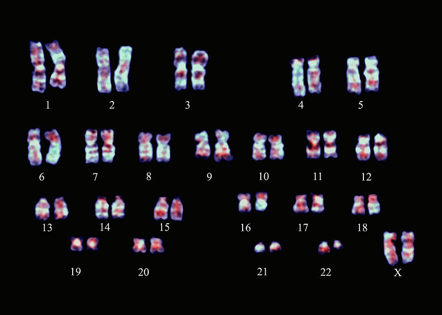 Philadelphia Chromosome #2 Photograph by Dept. Of Clinical Cytogenetics, Addenbrookes Hospital/science Photo Library