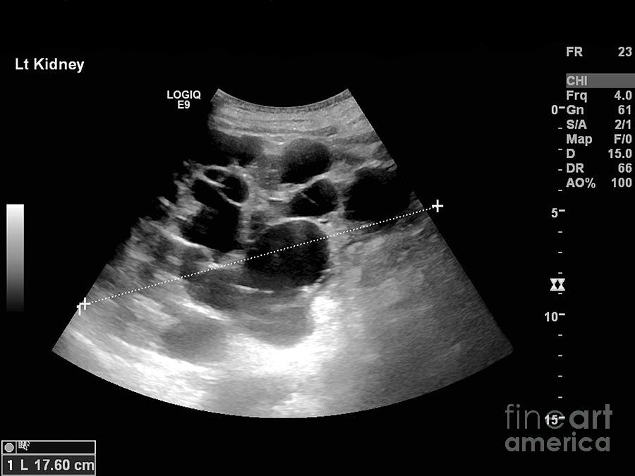 Polycystic Ultrasound Scan by Science Library