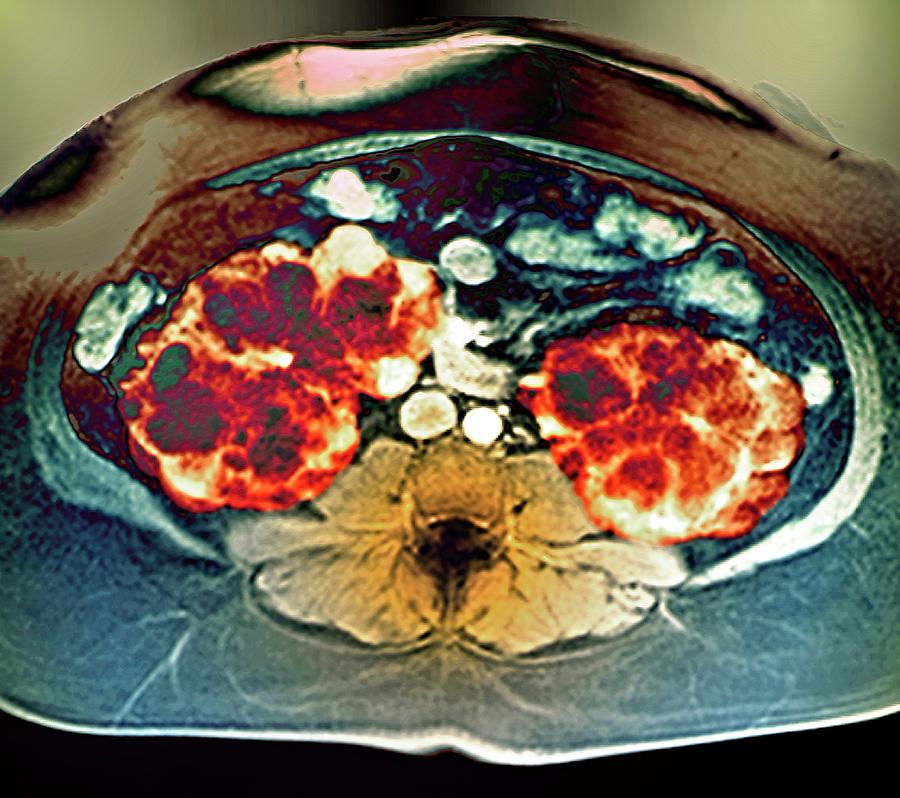 Polycystic Kidneys Photograph by Zephyr/science Photo Library - Fine ...