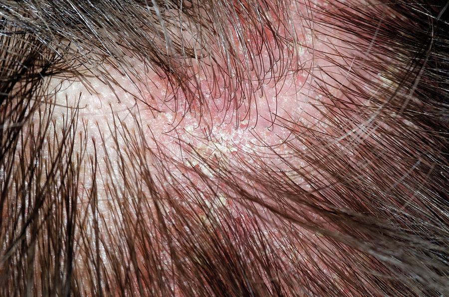 Psoriasis On The Scalp Photograph By Dr P Marazziscience Photo Library