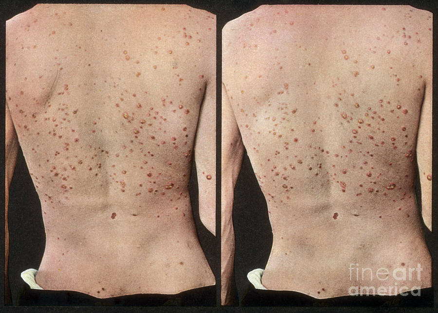 Rash Caused By Syphilis, Vintage #2 Photograph by DoubleVision