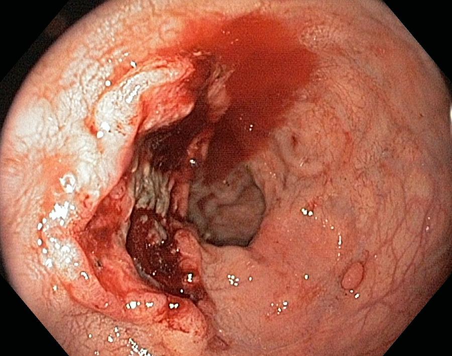 Rectal Cancer Photograph By Gastrolab Free Hot Nude Porn Pic Gallery