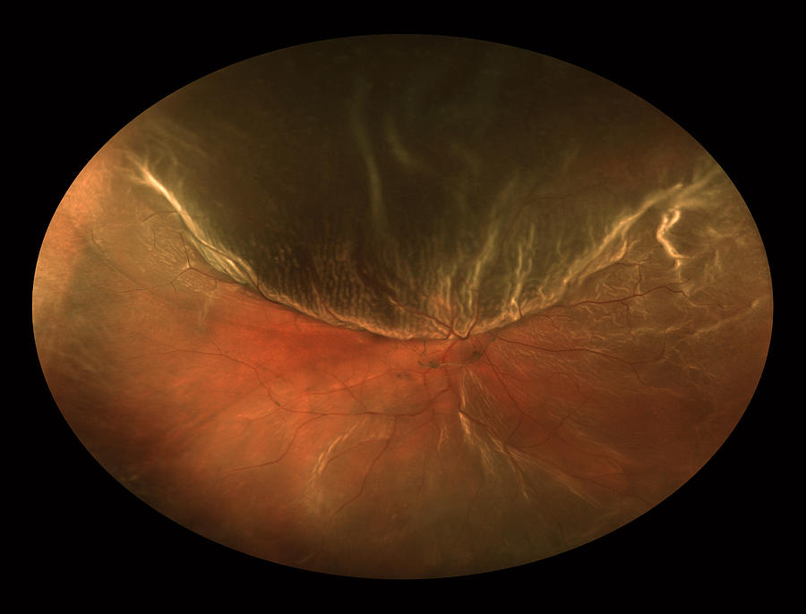 abnormal retinal scan
