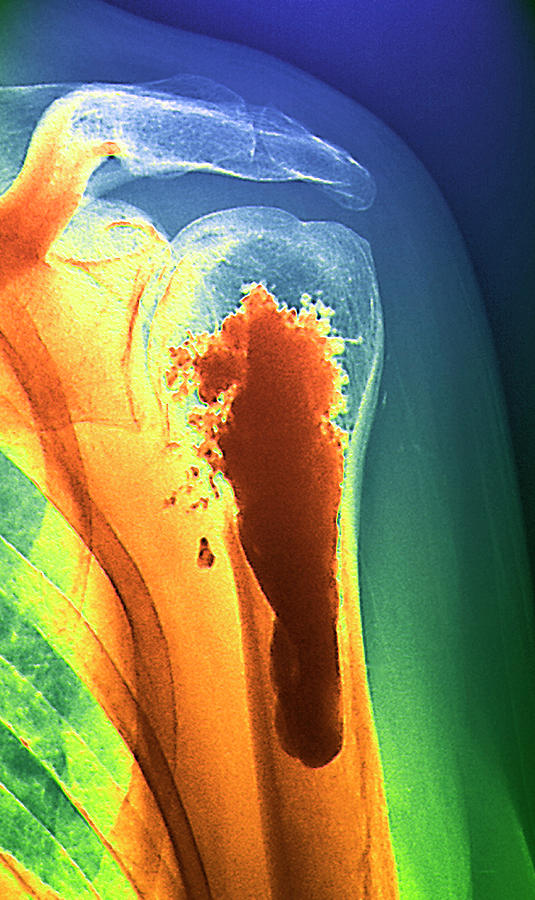 secondary-bone-cancer-photograph-by-simon-fraser-science-photo-library