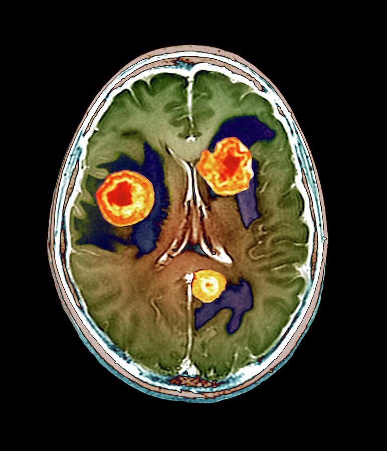 Secondary Brain Cancer Photograph by Zephyr/science Photo Library - Pixels