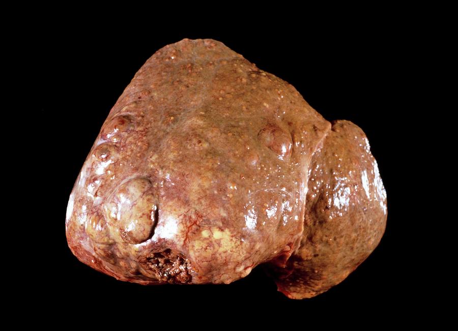 Liver Cancer Photograph - Secondary Cancers Of The Liver #2 by Cnri
