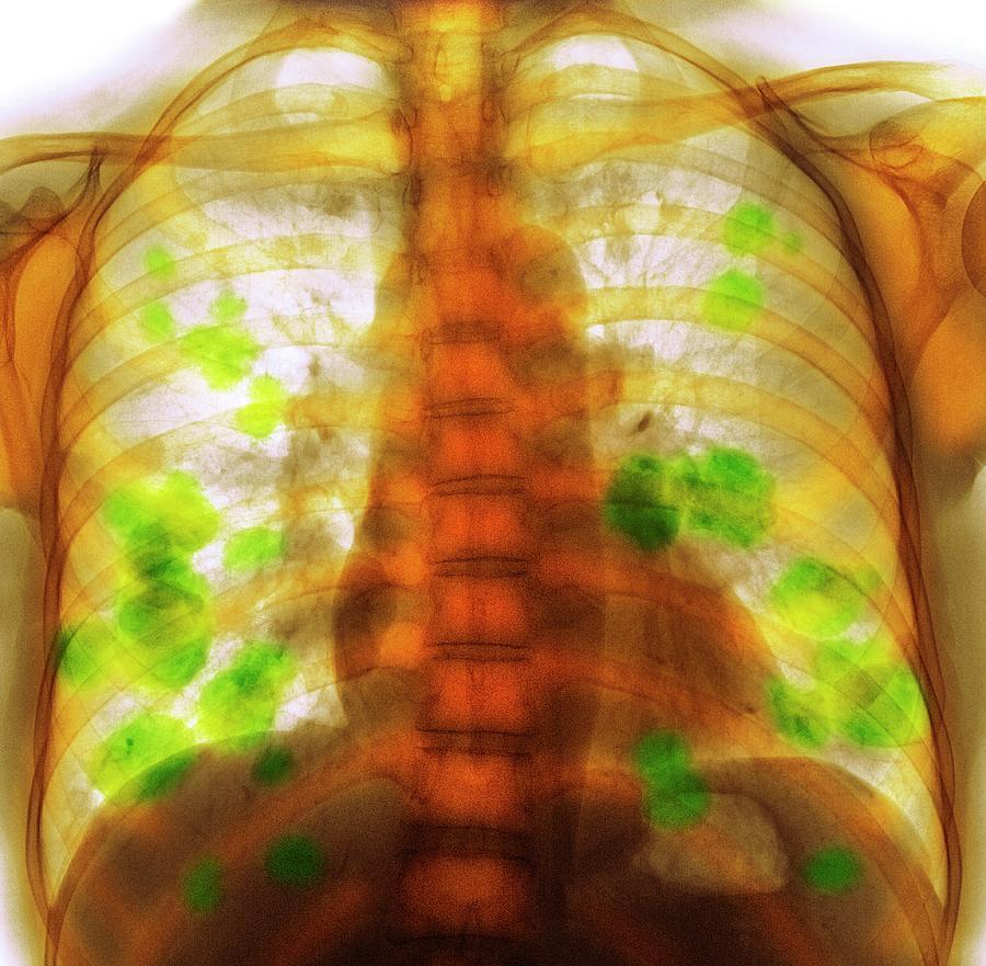 Secondary Lung Cancer Photograph by Science Photo Library - Fine Art ...