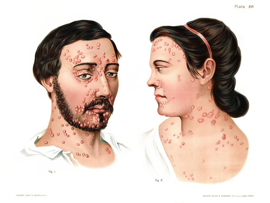 Secondary Syphilis Rash #2 Photograph by Us National Library Of Medicine/science Photo Library
