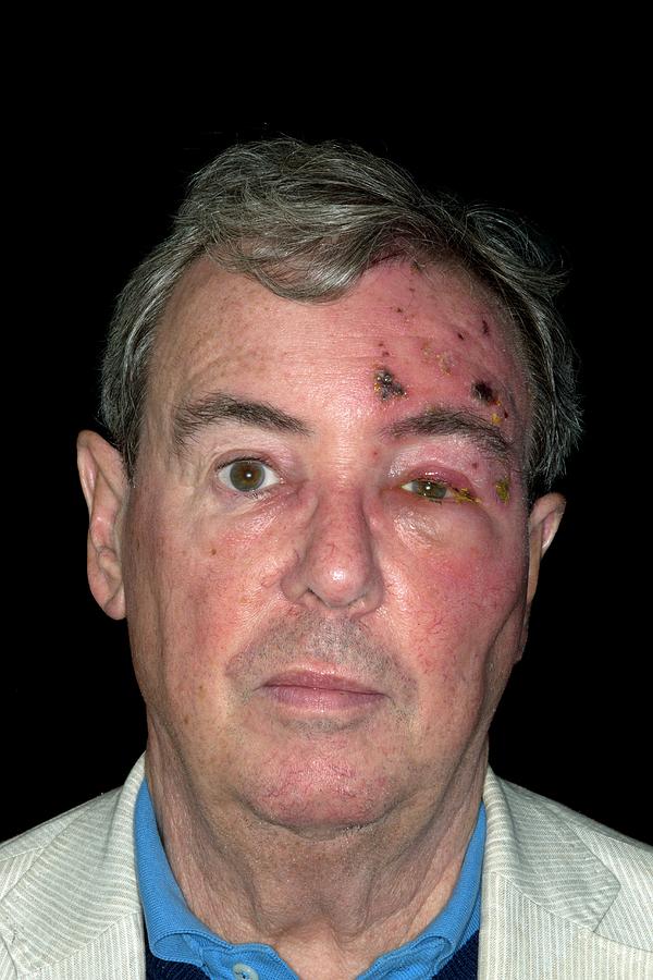 Shingles Rash On The Face Photograph by Dr P. Marazzi/science Photo Library