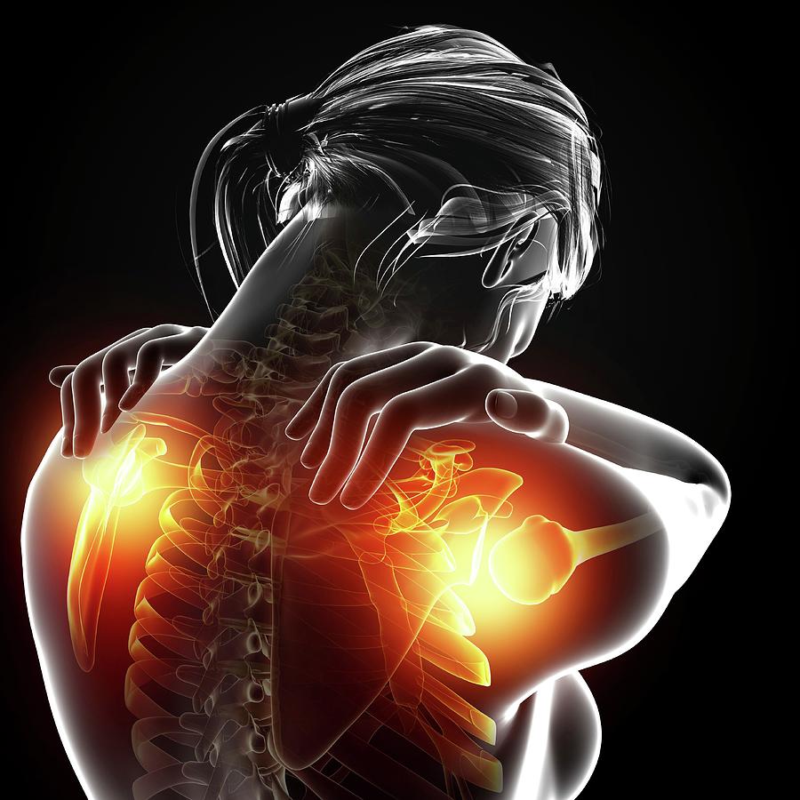 Shoulder Pain #2 Photograph by Pixologicstudio/science Photo Library