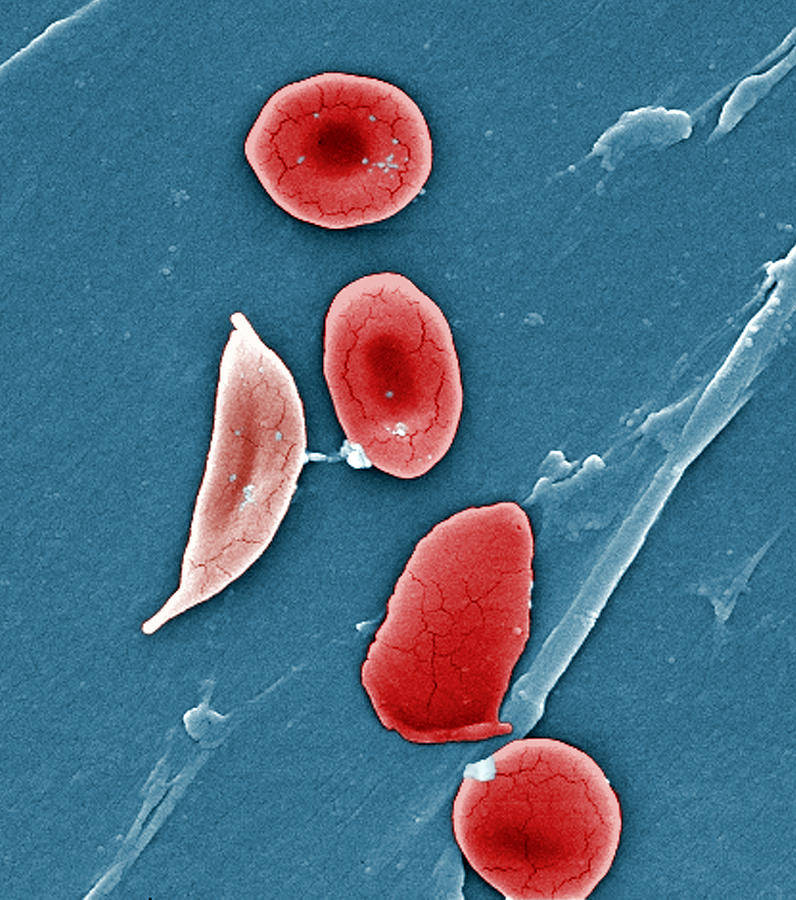 Science Photograph - Sickle Cell Anemia, Human Rbcs, Sem #2 by Science Source