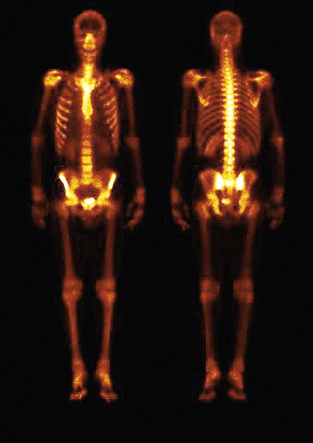 Skeleton Gamma Scans Photograph by Rvi Medical Physics, Newcastle/simon ...