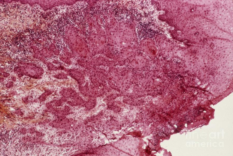 Squamous Cell Carcinoma Photograph - Skin Cancer, Light Micrograph #2 by Cnri