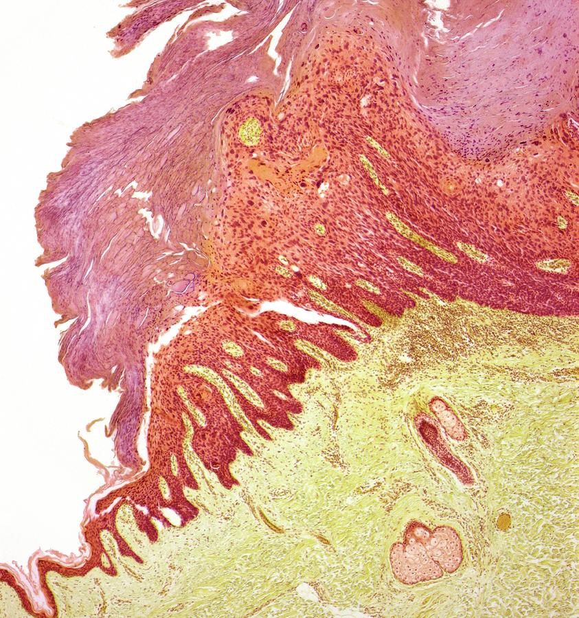 Squamous Cell Carcinoma Photograph - Skin Cancer #2 by Steve Gschmeissner