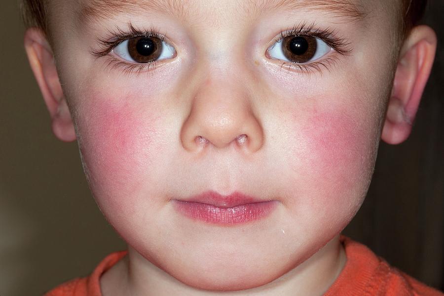 Slapped Cheek Disease Photograph By Dr P Marazziscience Photo Library