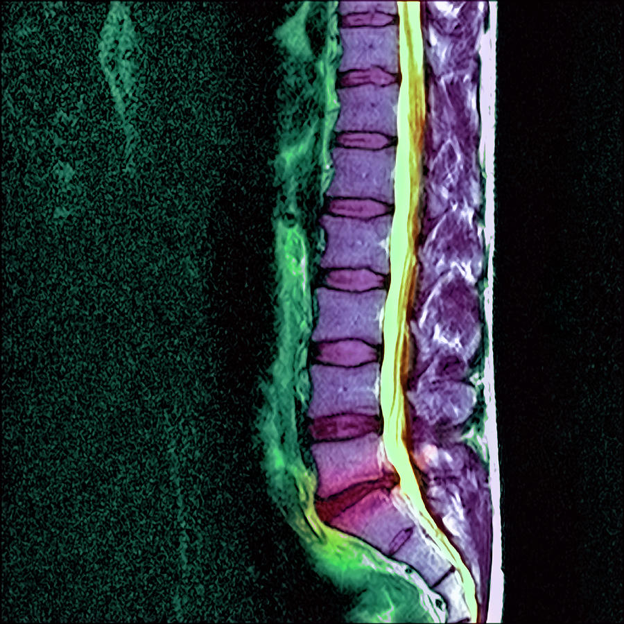 Slipped Disc #2 Photograph by Simon Fraser/science Photo Library